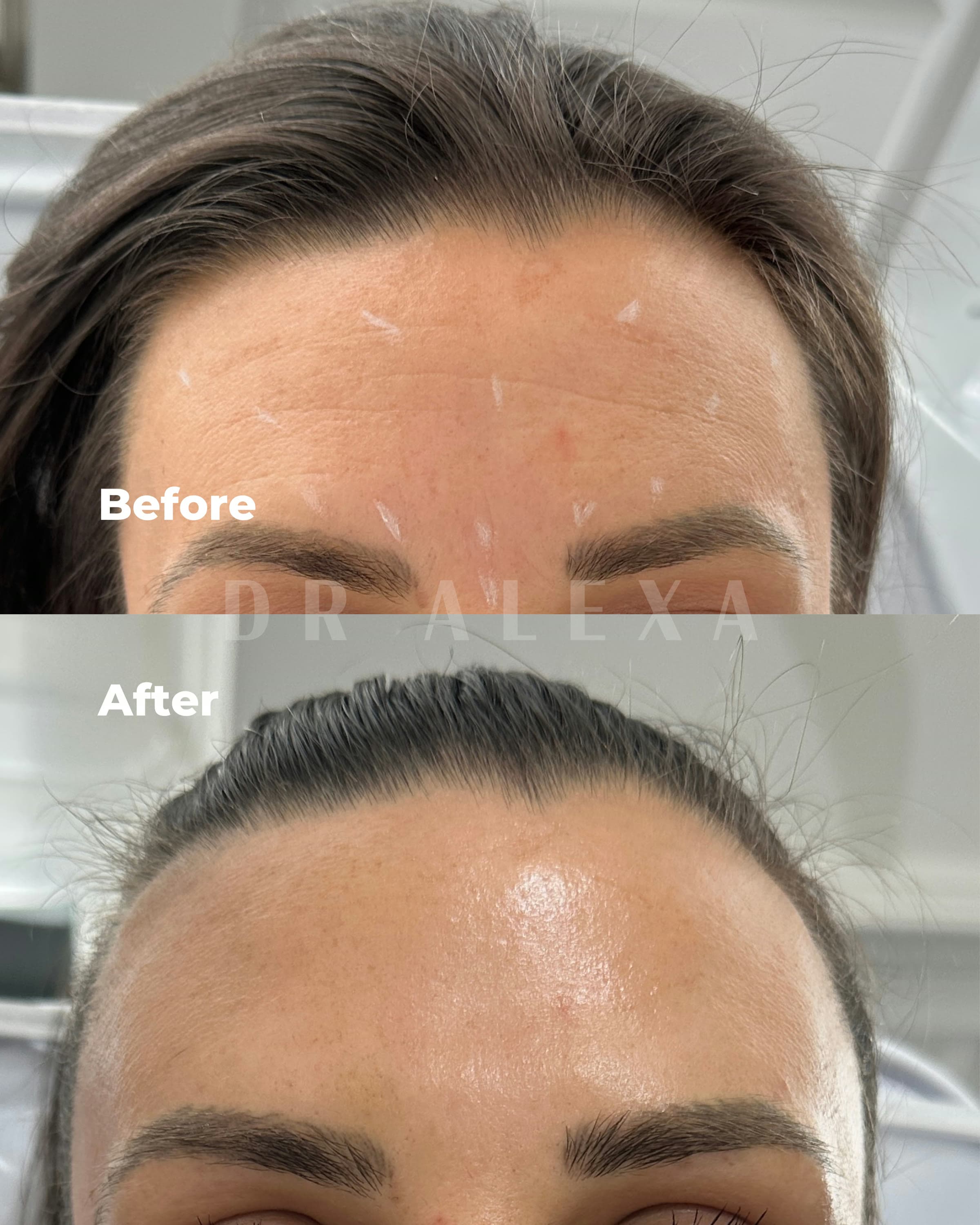 Anti-Wrinkle Injections before and after — case 1, Dr Alexa Mayfair
