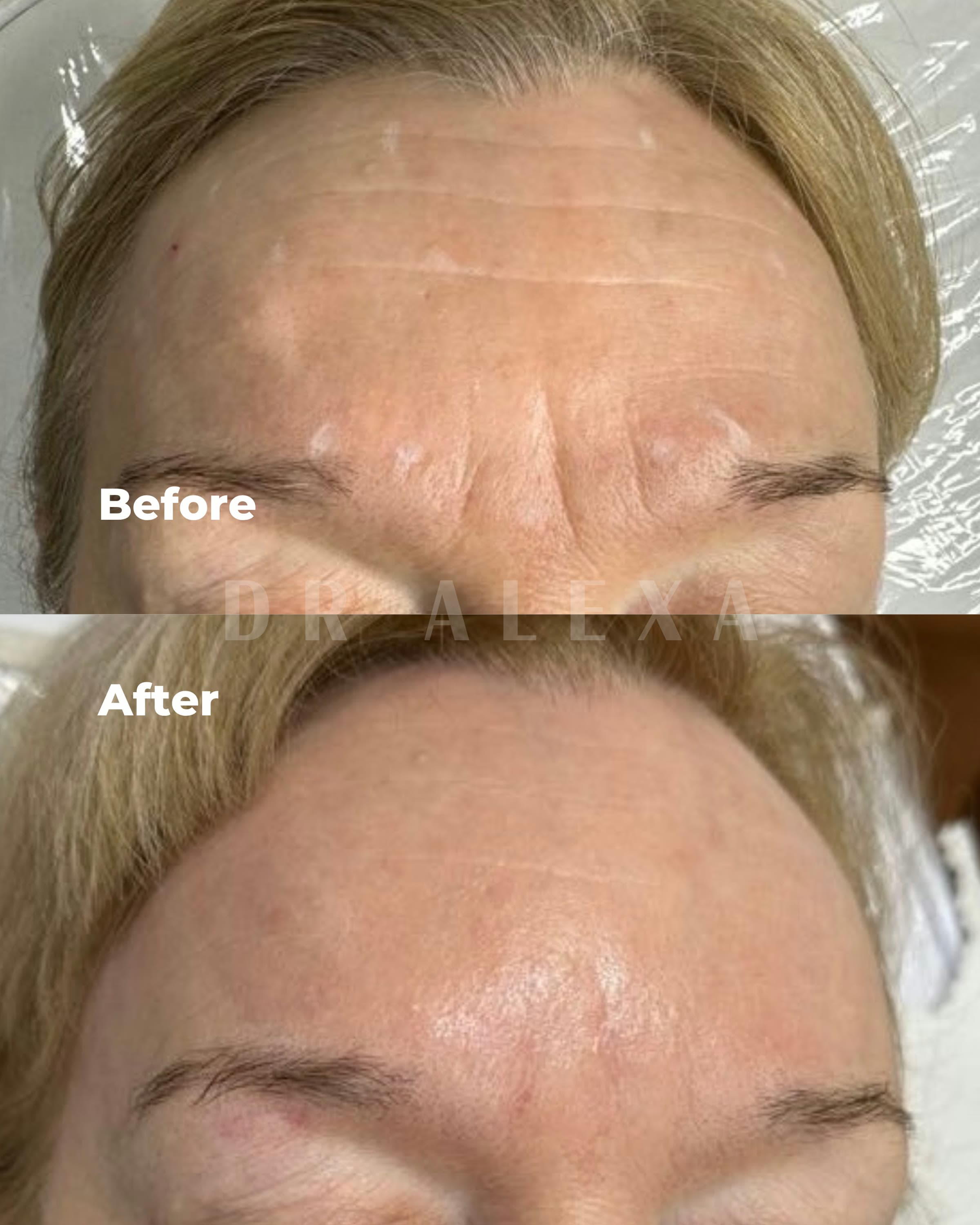 Anti-Wrinkle Injections before and after — case 2, Dr Alexa Mayfair