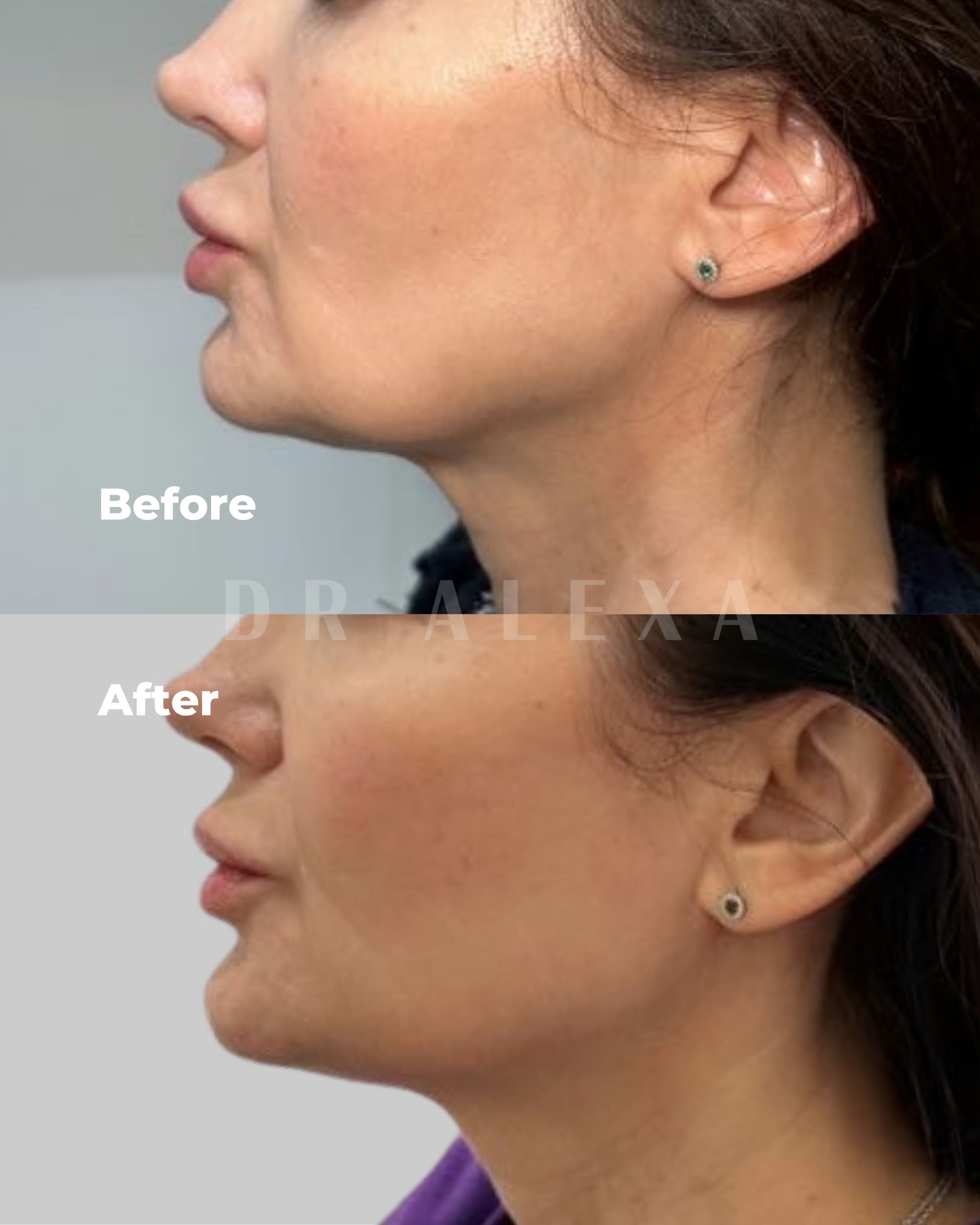 Biostimulators before and after — case 2, Dr Alexa Mayfair