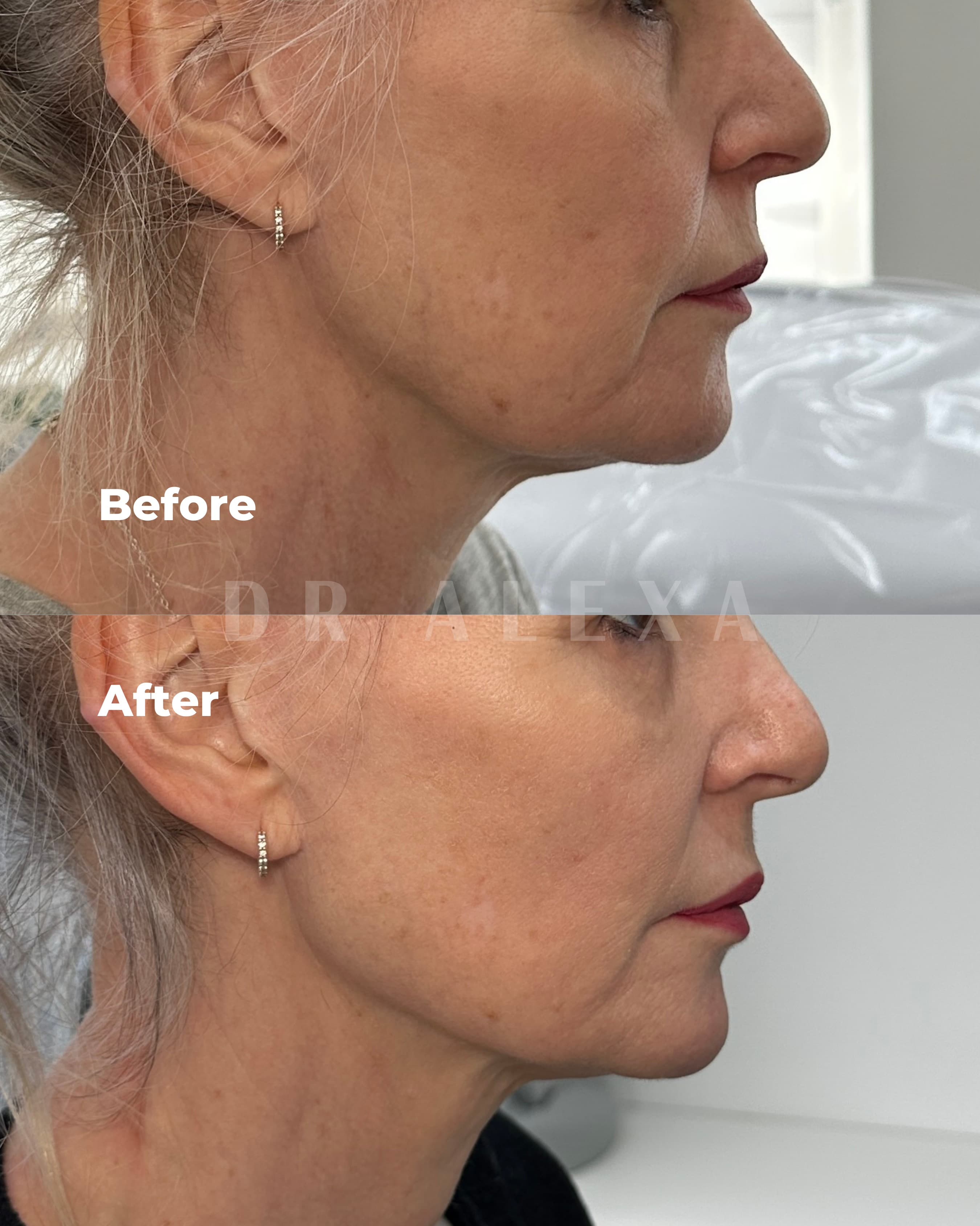 Biostimulators before and after — case 3, Dr Alexa Mayfair