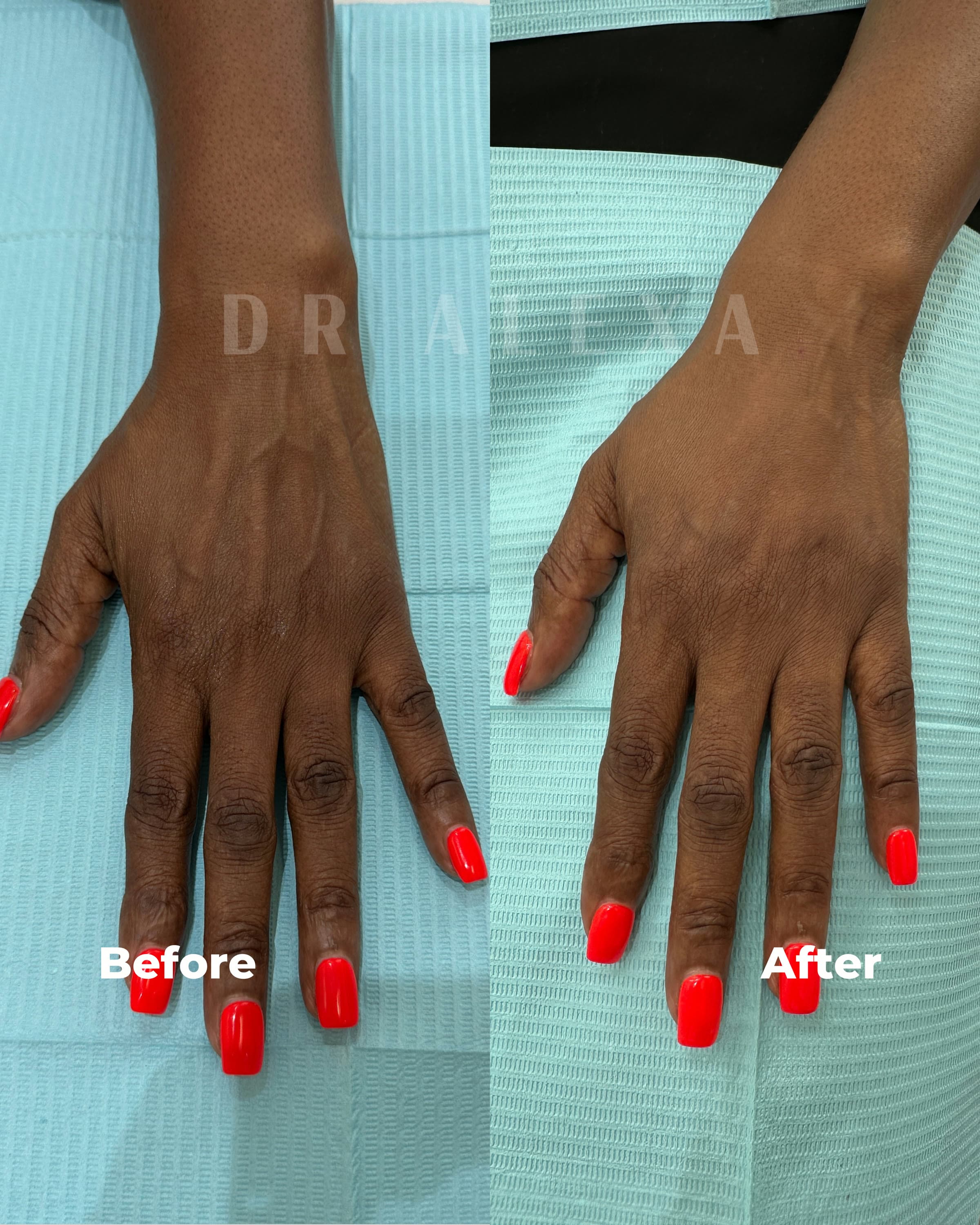 Dermal Fillers before and after — case 2, Dr Alexa Mayfair