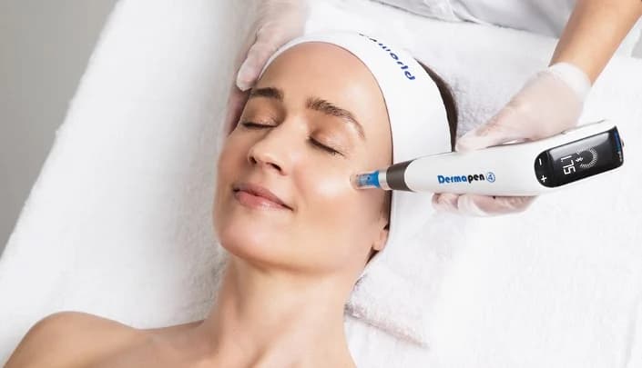 Dermapen Microneedling for Acne Scarring at Dr Alexa, London