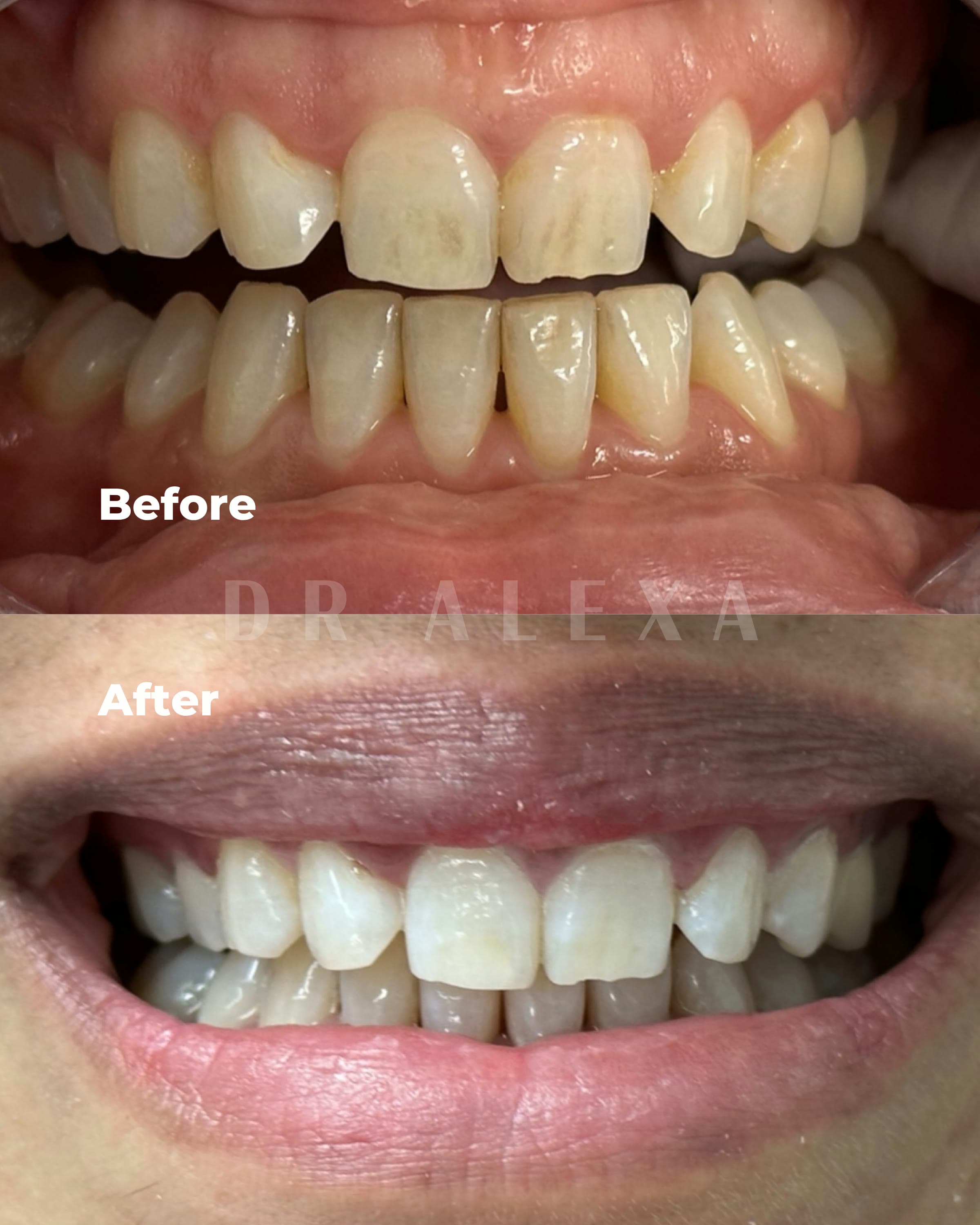 Philips ZOOM Teeth Whitening before and after — case 3, Dr Alexa Mayfair