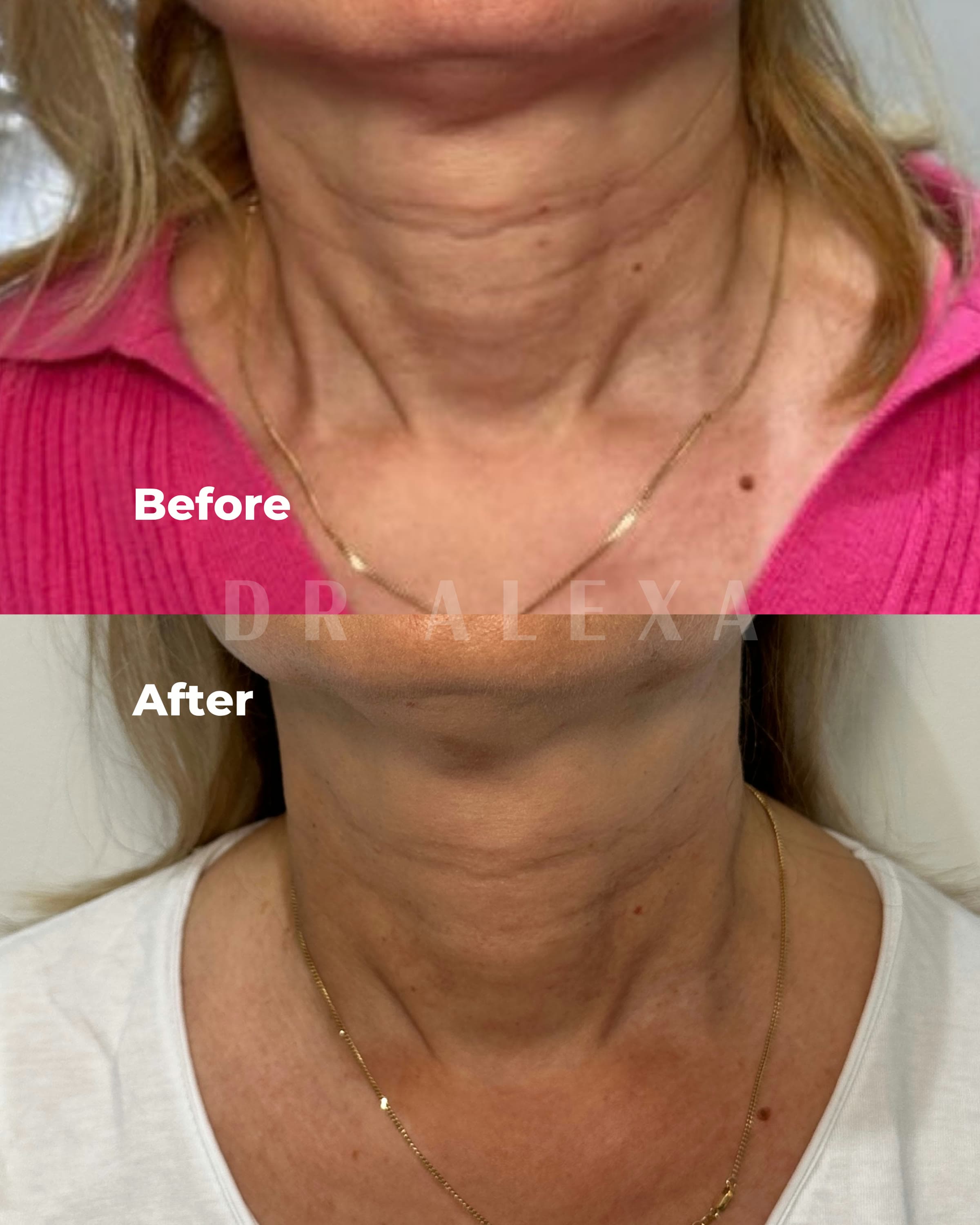 Sculptra before and after — case 1, Dr Alexa Mayfair