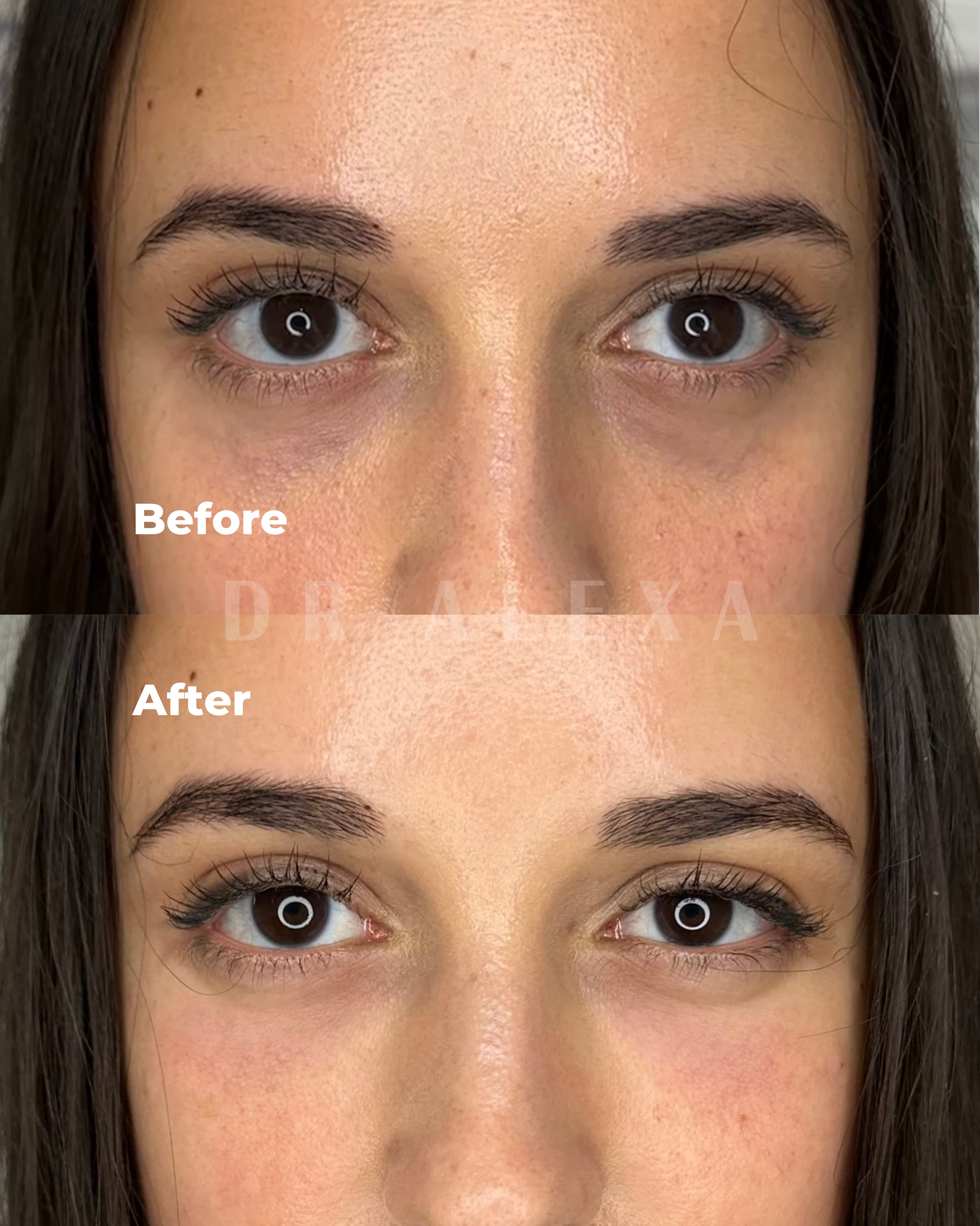 SuneKos before and after — case 1, Dr Alexa Mayfair