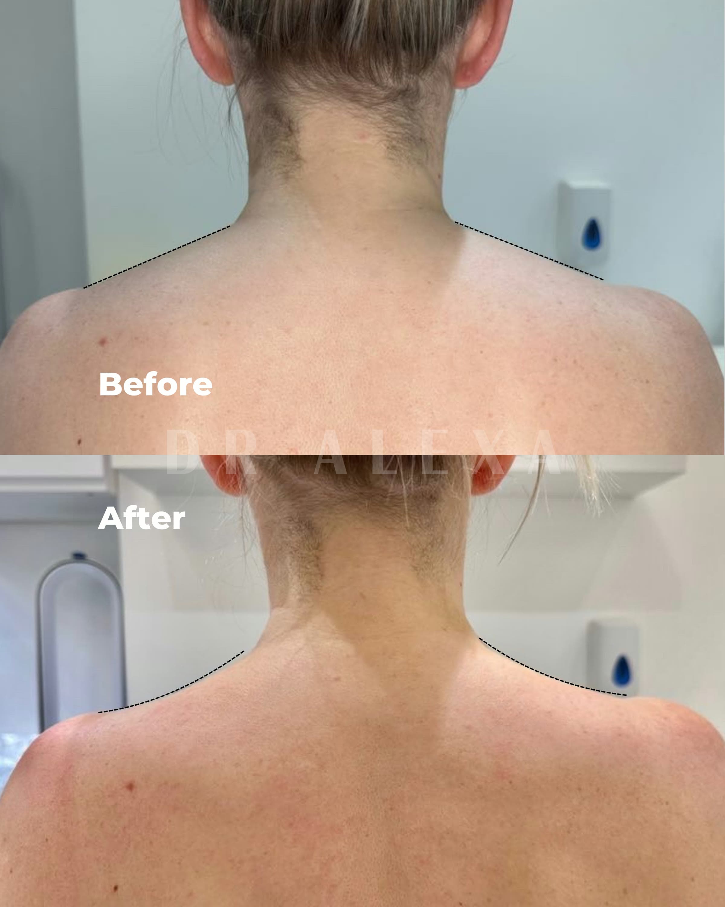 Trapezius Slimming before and after — case 1, Dr Alexa Mayfair