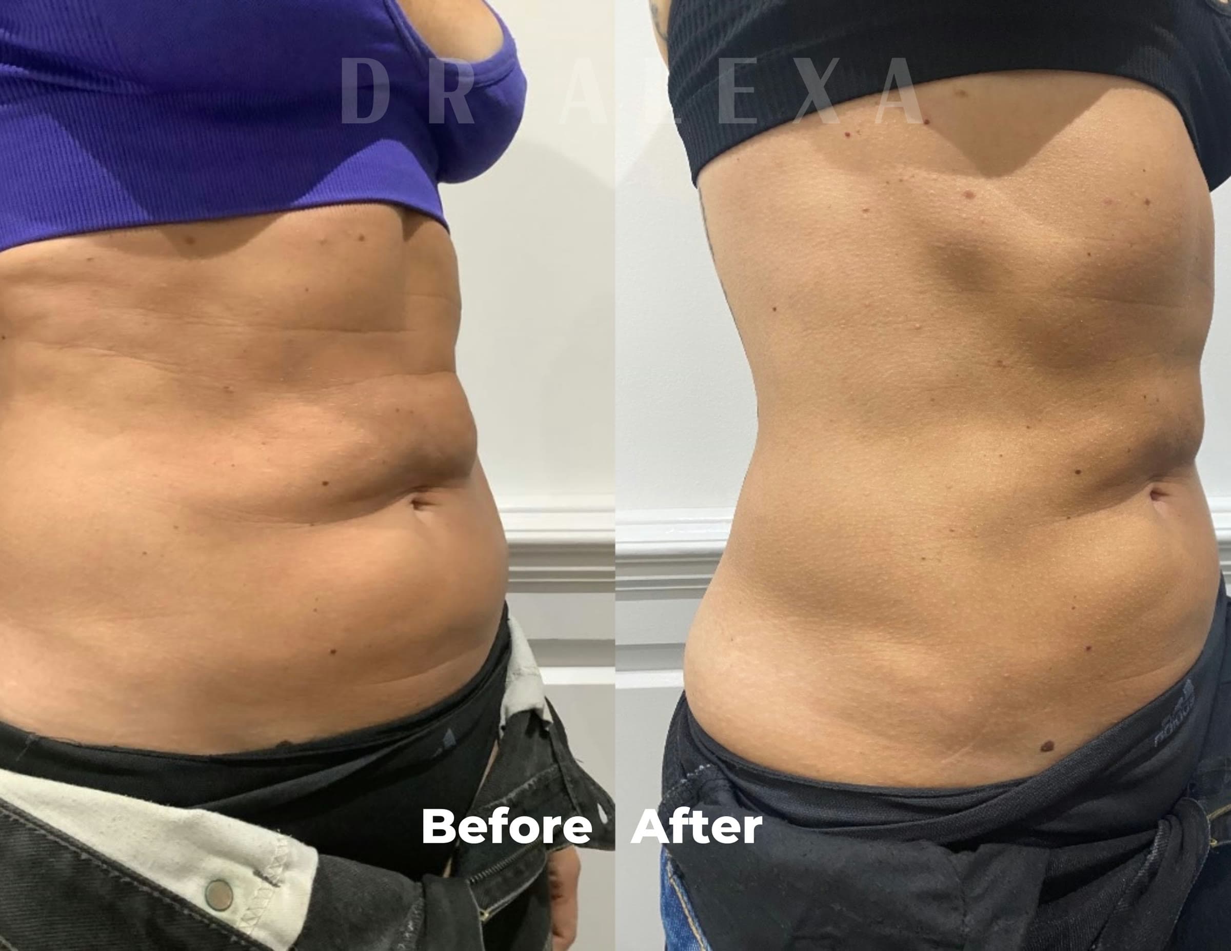 Weight Loss Management before and after — case 2, Dr Alexa Mayfair